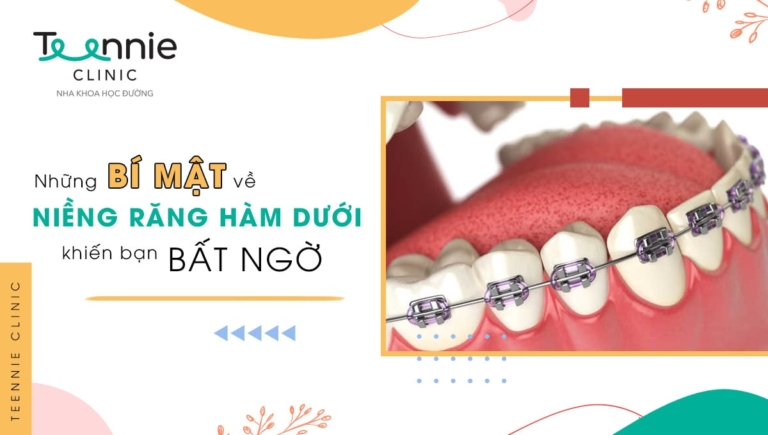 Những bật mí về niềng răng hàm dưới khiến bạn bất ngờ