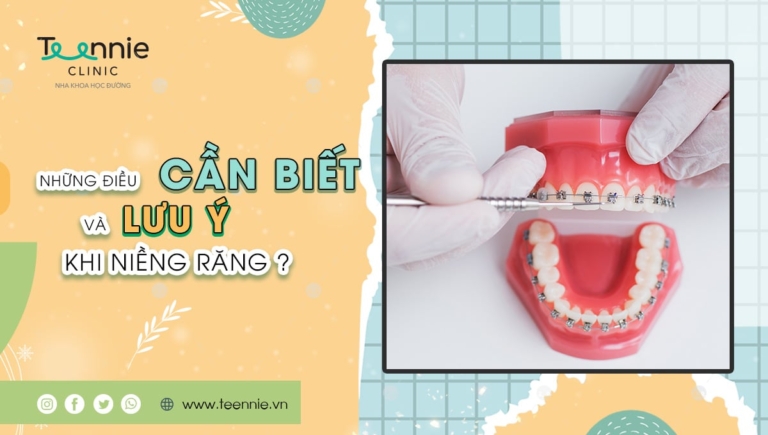 Những điều cần biết và lưu ý khi niềng răng