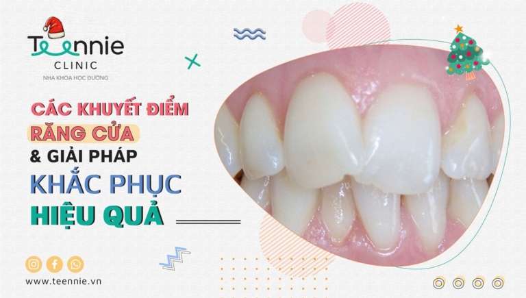 Những điều cần biết về các khuyết điểm và phương pháp niềng răng cửa