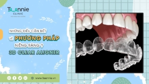 Những điều cần biết về phương pháp niềng răng 3D Clear Aligner