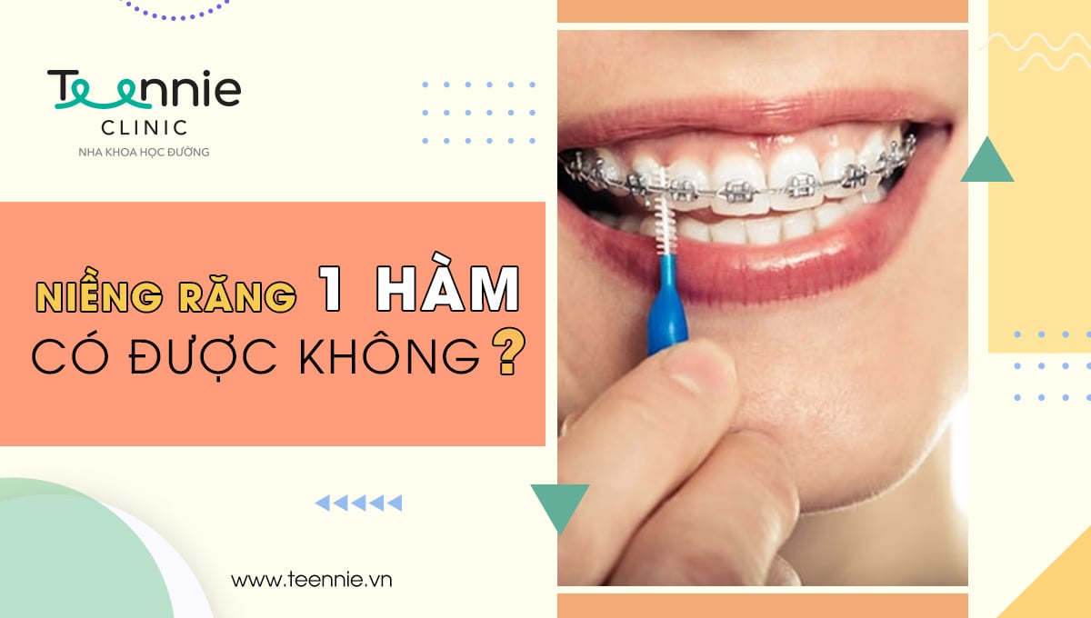 Niềng răng 1 hàm có được không?