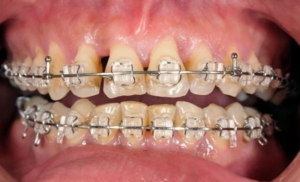 Niềng răng bị tụt lợi: Nguyên nhân và cách khắc phục!