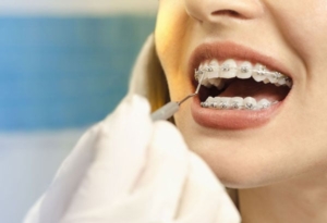 Niềng răng bị tụt lợi: Nguyên nhân và cách khắc phục!