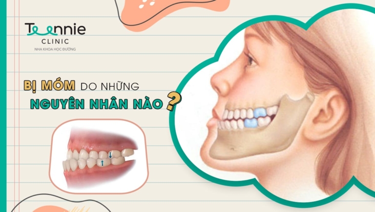 Niềng răng có hết móm thắc mắc của nhiều người?