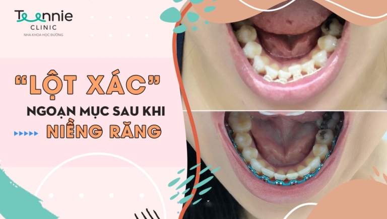 Niềng răng đẹp cỡ nào? Hình ảnh thay đổi trước và sau khi niềng răng