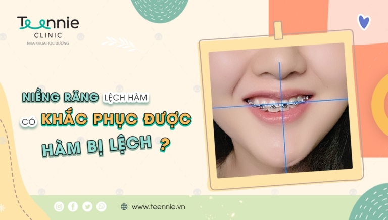 Niềng răng lệch hàm có khắc phục được hàm bị lệch không?