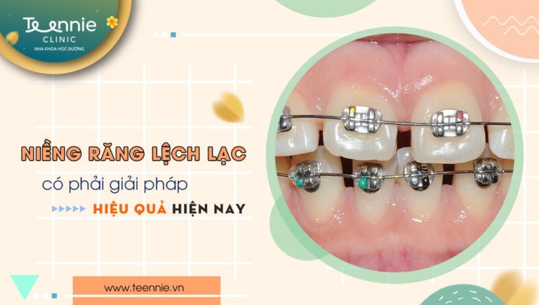 Niềng răng lệch lạc có phải giải pháp hiệu quả hiện nay?