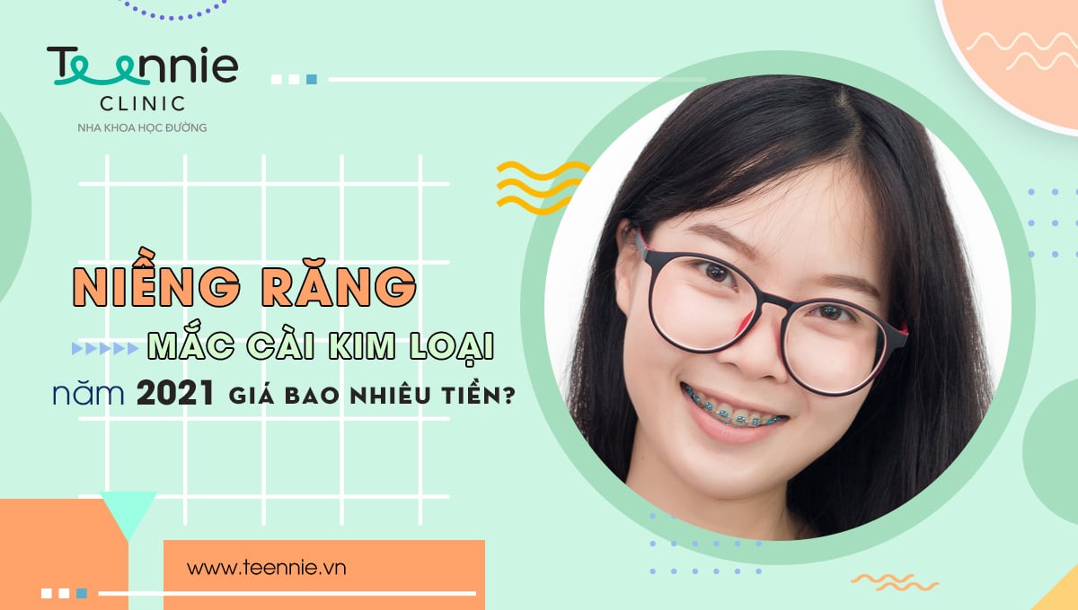 Niềng răng mắc cài kim loại năm 2021 giá bao nhiêu tiền?