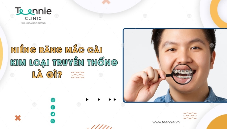 Niềng răng mắc cài kim loại truyền thống là gì? Có tốt không?