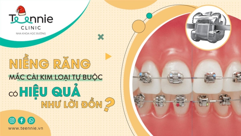 Niềng răng mắc cài kim loại tự buộc có hiệu quả như lời đồn?