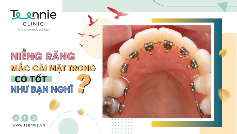 Niềng răng mắc cài mặt trong có thực sự tốt như bạn nghĩ?