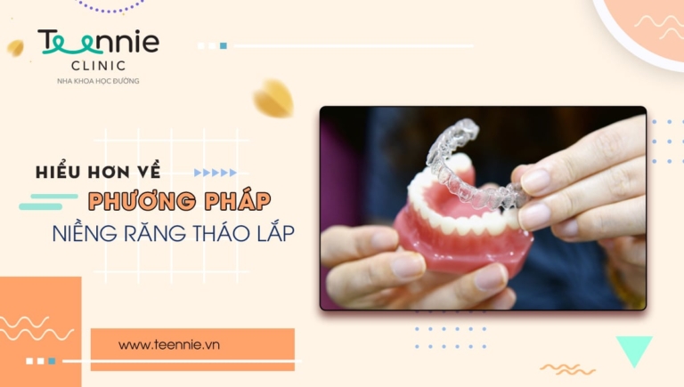 Niềng răng tháo lắp là gì? Có thực sự mang lại hiệu quả?