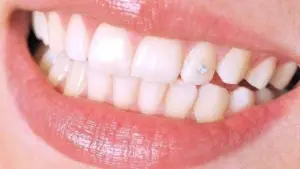 Quá trình gắn đá lên răng như thế nào?