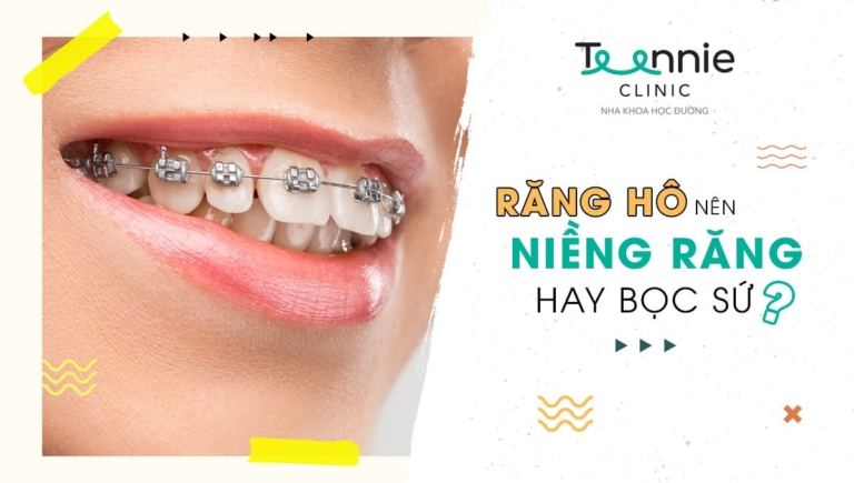 Răng hô nên niềng hay bọc sứ? Phương pháp nào tốt hơn?