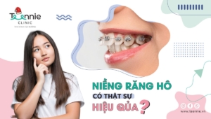 Răng hô nguyên nhân do đâu? Niềng răng hô có thực sự hiệu quả?