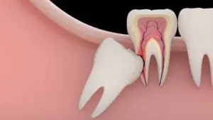 Răng mọc ngầm có nguy hiểm gì không?