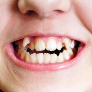Răng mọc thừa có cần phải nhổ bỏ?