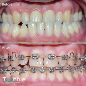 Trước và sau khi niềng răng móm