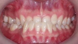 Răng móm ảnh hưởng tính cách và vận mệnh ra sao?