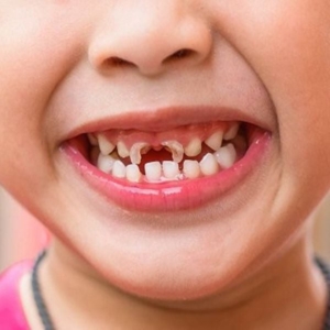 Sâu răng do ăn kẹo ở trẻ điều trị như thế nào?