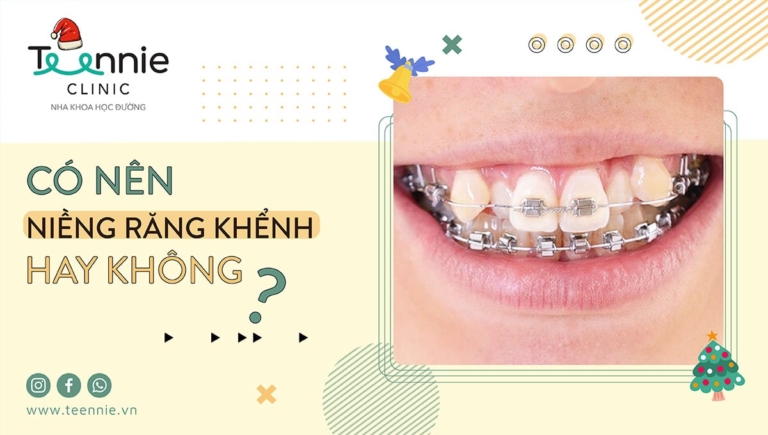 Sở hữu răng khểnh có phải điều may mắn? Và có nên niềng hay không?