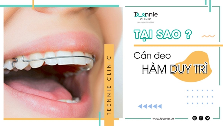 Tại sao cần đeo hàm duy trì sau khi niềng răng?