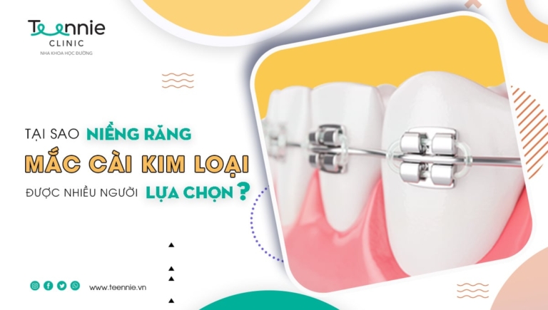 Tại sao niềng răng mắc cài kim loại được nhiều người lựa chọn?