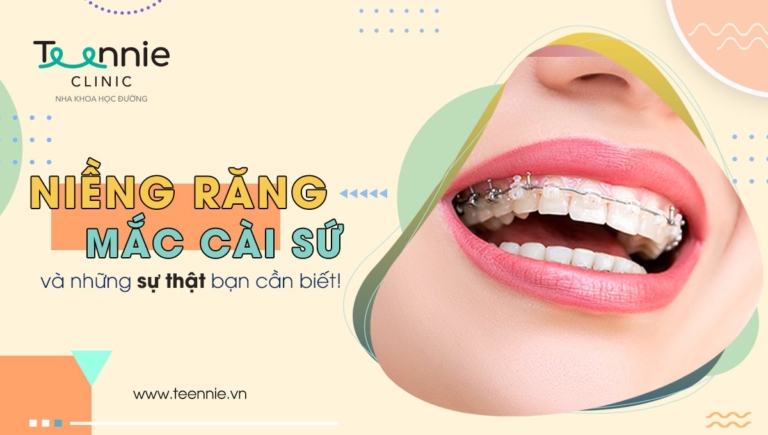 Tại sao niềng răng mắc cài sứ lại được nhiều người ưa chuộng?