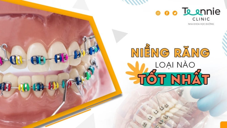 Tất tần tật về niềng răng thẩm mỹ là gì?