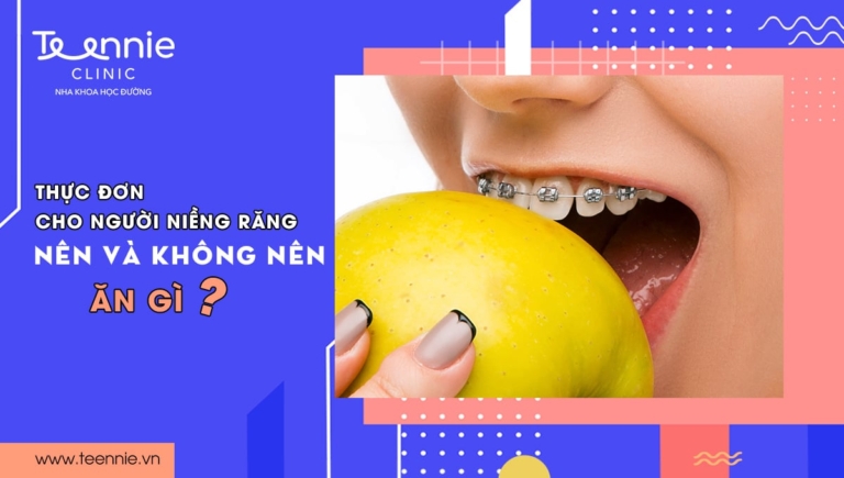 Thực đơn cho người niềng răng: Nên và không nên ăn gì?