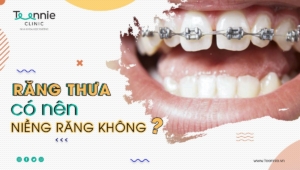 Tiết lộ sự thật về răng thưa có nên niềng răng hay không?