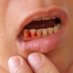 Tình trạng chảy máu chân răng nên ăn gì?