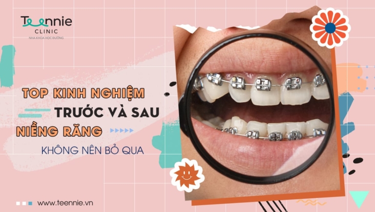 Top kinh nghiệm trước và sau niềng răng không nên bỏ qua