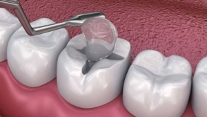 Trám răng tạm thời có bền hay không?