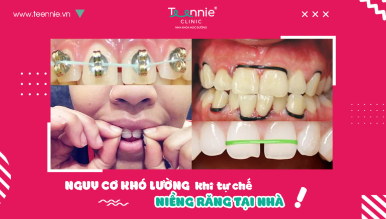 Niềng răng tại nhà có tốt không?