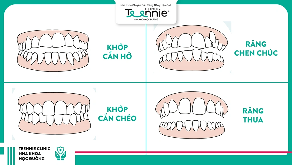 Tình trạng răng là yếu tố ảnh hưởng lớn nhất đến giá niềng răng