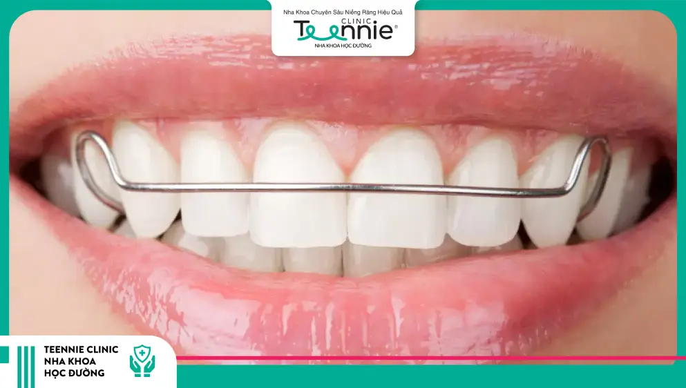 Hàm duy trì sau khi niềng răng giữ cho răng đúng vị trí