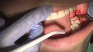 Nhổ răng số 7 có nên hay không?