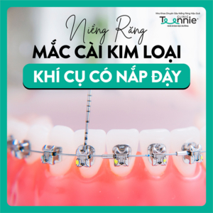 Niềng răng mắc cài khí cụ có nắp đậy