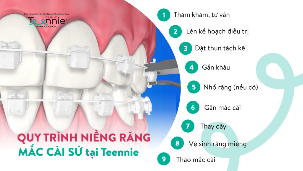 09 bước niềng răng chuẩn y khoa tại Teennie 