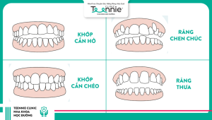 Các trường hợp phù hợp với nguyên lý niềng răng dây thẳng