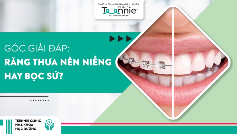 Góc giải đáp: Răng thưa nên niềng hay bọc sứ?