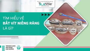 Bắt vít niềng răng (Minivis) là gì? Bắt vít có đau không?