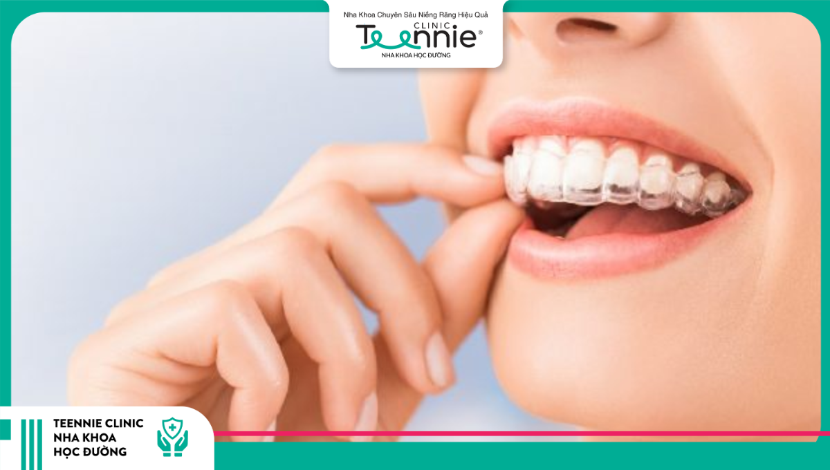 Cập nhập bảng giá niềng răng trong suốt Invisalign