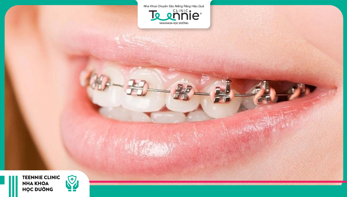 Tuỳ vào tình trạng răng hô của bạn có thể có hoặc không