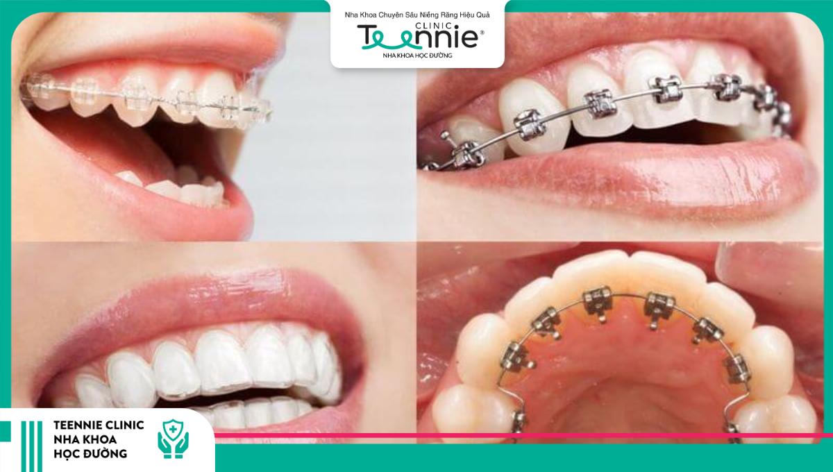 Niềng răng hô giúp điều chỉnh hàm về vị trí mới đều và đẹp