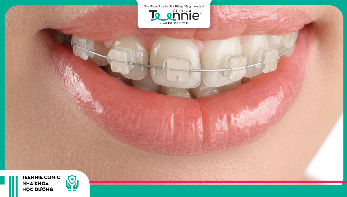 Niềng răng mắc cài sứ giúp tăng tính thẩm mỹ  