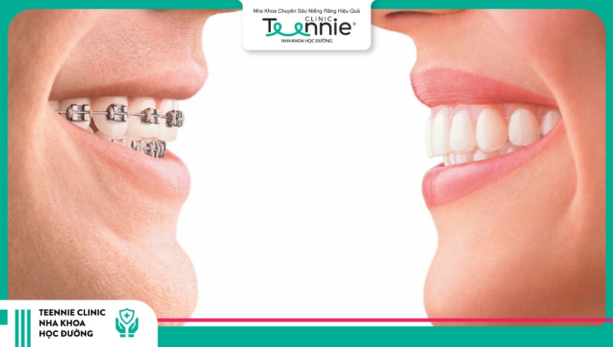 Người niềng răng có thể hôn bình thường được