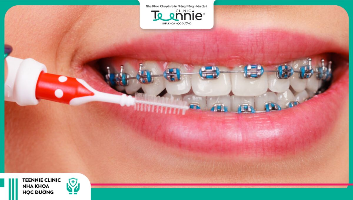 Vệ sinh răng miệng kỹ càng là mẹo hôn khi niềng răng cần lưu ý hàng đầu