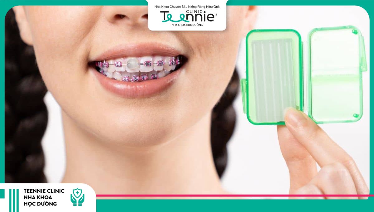 Sử dụng sáp nha khoa giúp cảm giác khi hôn người niềng răng dễ chịu hơn